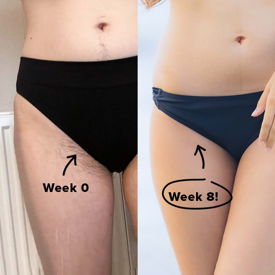 5MINSKIN AT-HOME LASER HAIR REMOVAL HANDSET - 50% OFF MOTHER'S DAY SALE
