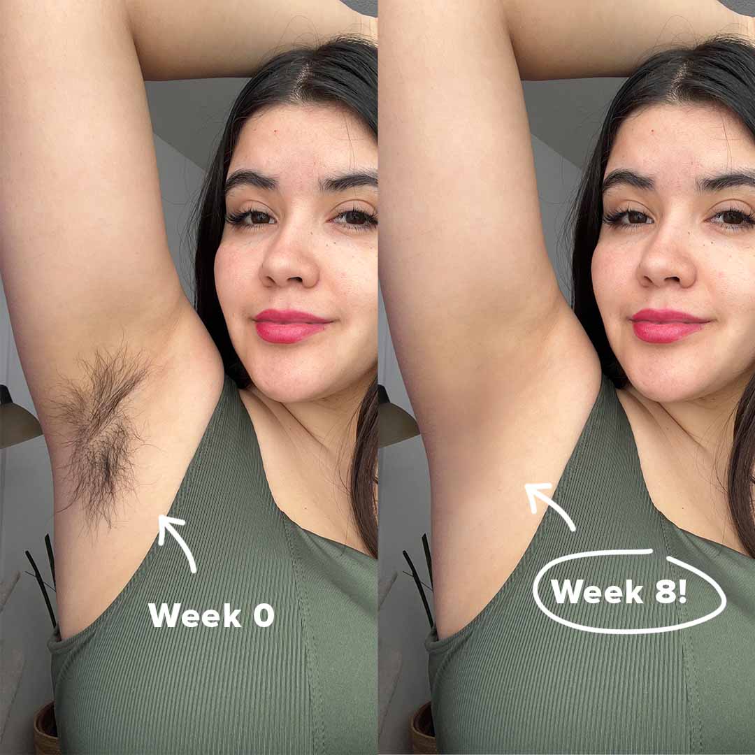 5MINSKIN AT-HOME LASER HAIR REMOVAL HANDSET - 50% OFF MOTHER'S DAY SALE